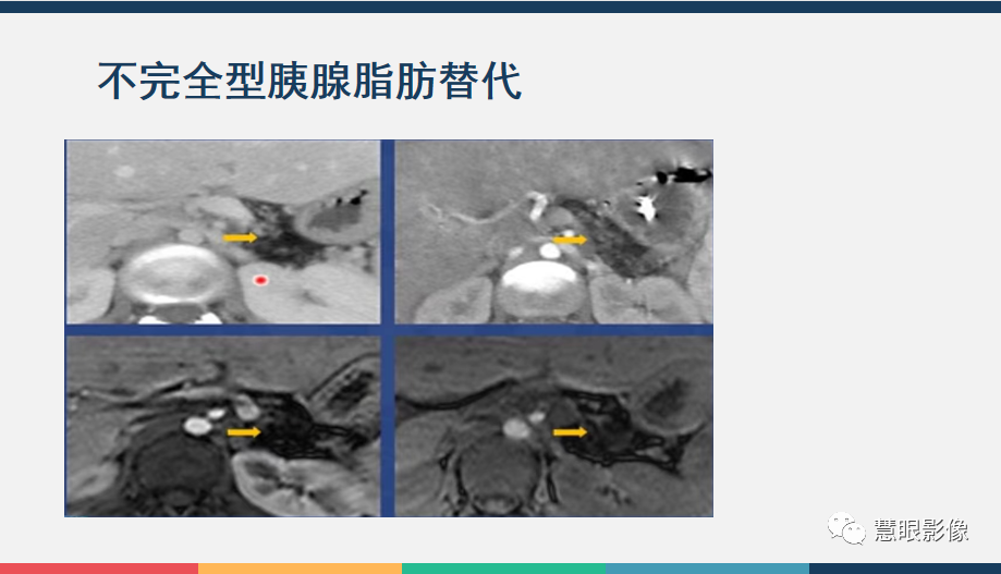 影像PPT - 【PPT】胰腺解剖变异、发育异常及相关病变影像评估-30