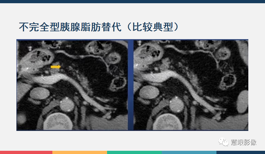 影像PPT - 【PPT】胰腺解剖变异、发育异常及相关病变影像评估-31