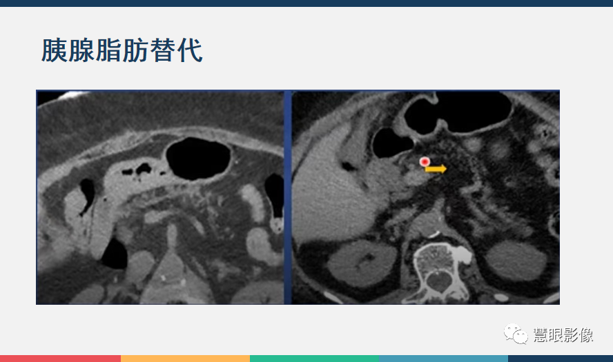 影像PPT - 【PPT】胰腺解剖变异、发育异常及相关病变影像评估-32