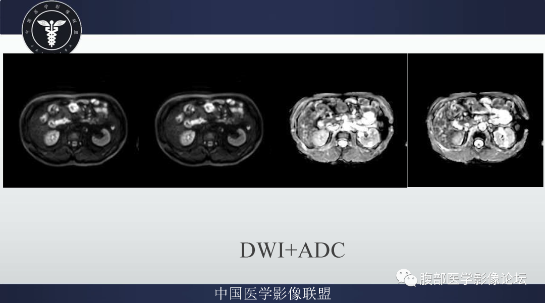 影像PPT - 【病例】肠系膜侵袭性纤维瘤病1例MR影像-5