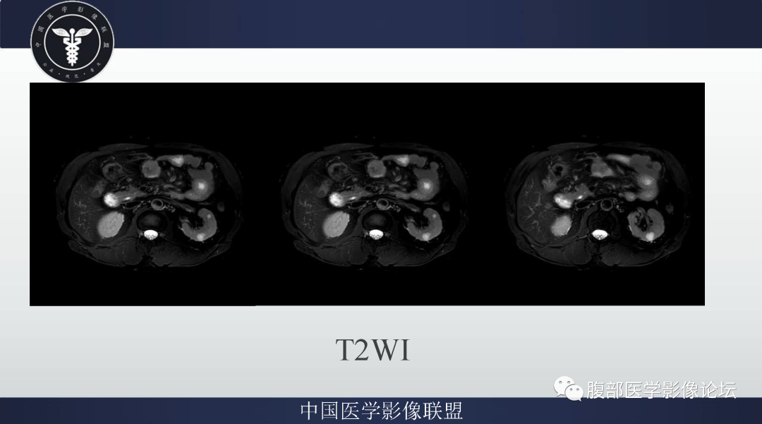 影像PPT - 【病例】肠系膜侵袭性纤维瘤病1例MR影像-4