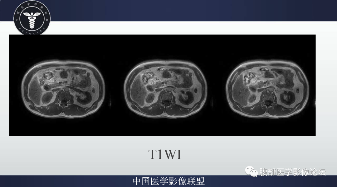影像PPT - 【病例】肠系膜侵袭性纤维瘤病1例MR影像-3