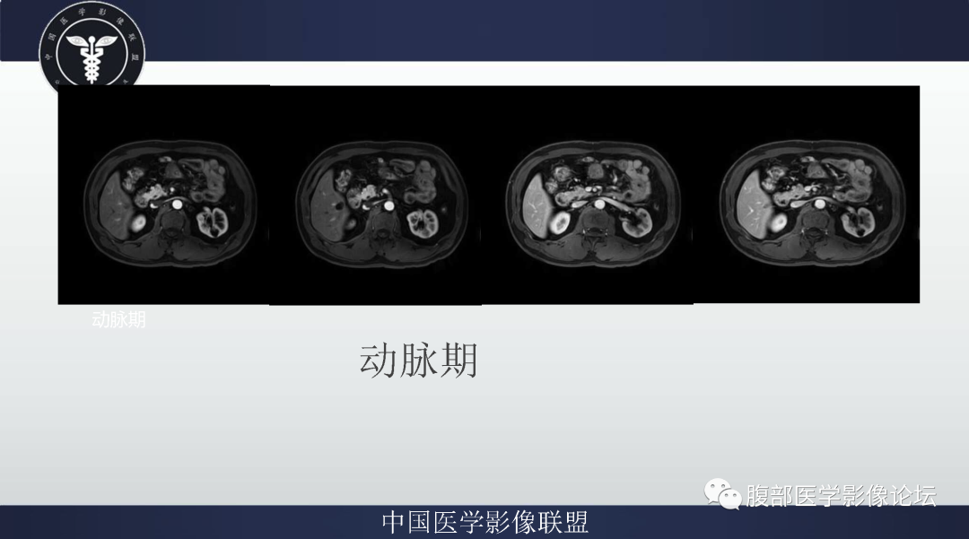 影像PPT - 【病例】肠系膜侵袭性纤维瘤病1例MR影像-6