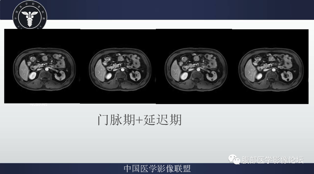影像PPT - 【病例】肠系膜侵袭性纤维瘤病1例MR影像-7