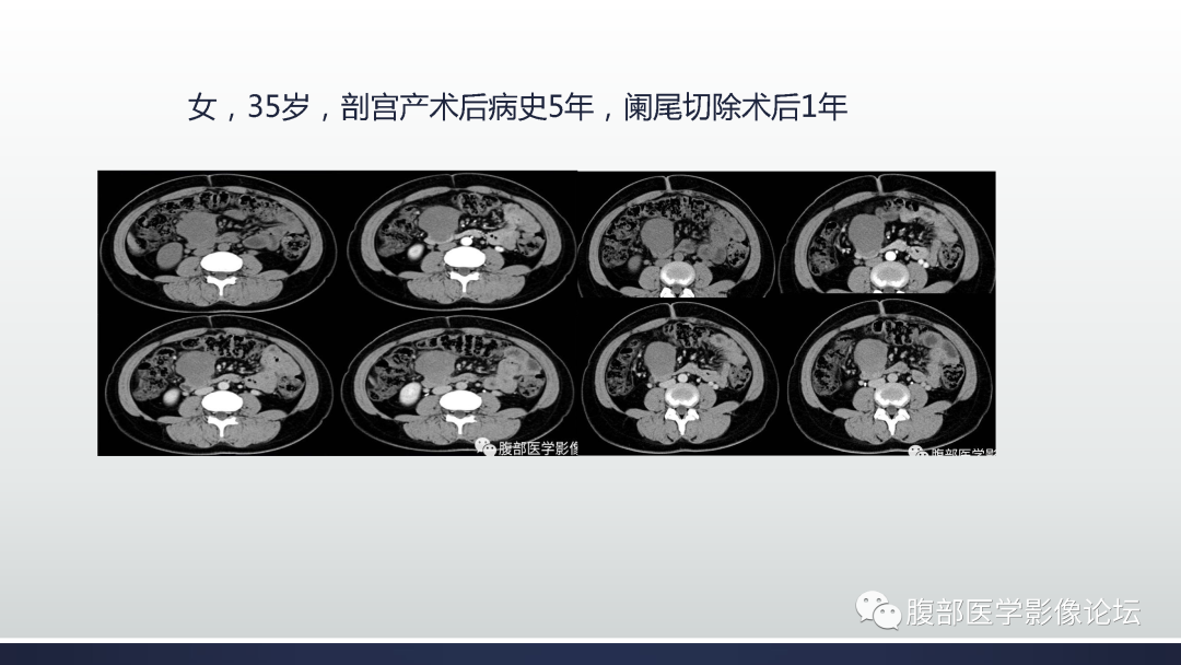影像PPT - 【病例】肠系膜侵袭性纤维瘤病1例MR影像-12