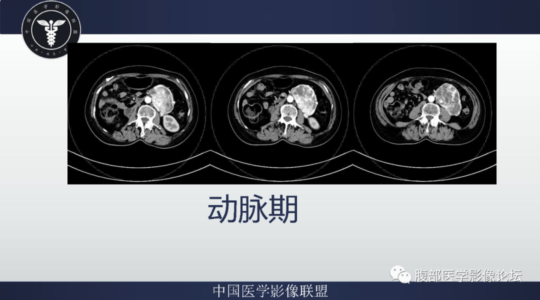 影像PPT - 【病例】腹膜后副神经节瘤1例CT影像-5