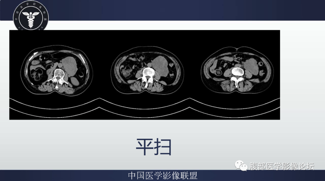 影像PPT - 【病例】腹膜后副神经节瘤1例CT影像-4