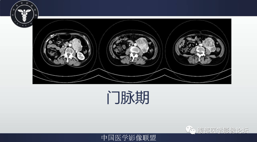 影像PPT - 【病例】腹膜后副神经节瘤1例CT影像-6