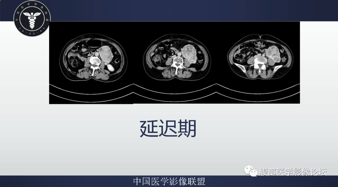 影像PPT - 【病例】腹膜后副神经节瘤1例CT影像-7