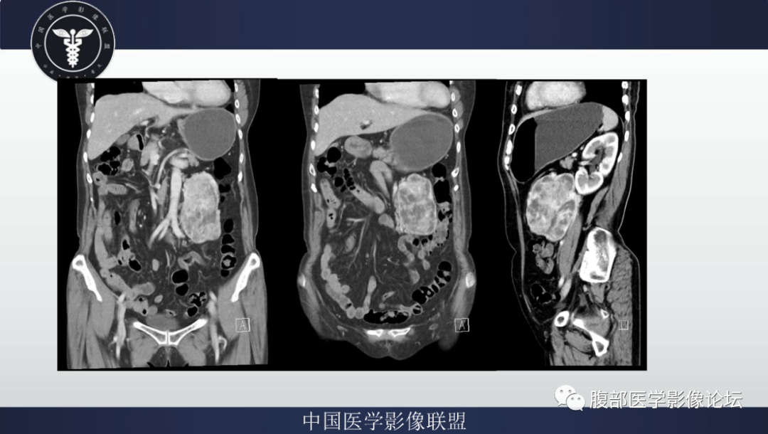 影像PPT - 【病例】腹膜后副神经节瘤1例CT影像-8