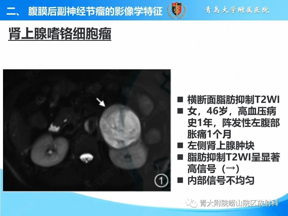 影像PPT - 【病例】腹膜后副神经节瘤1例CT影像-21
