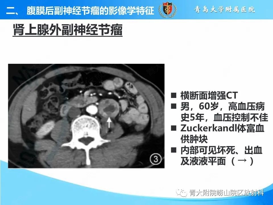 影像PPT - 【病例】腹膜后副神经节瘤1例CT影像-25