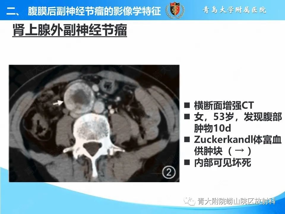 影像PPT - 【病例】腹膜后副神经节瘤1例CT影像-24