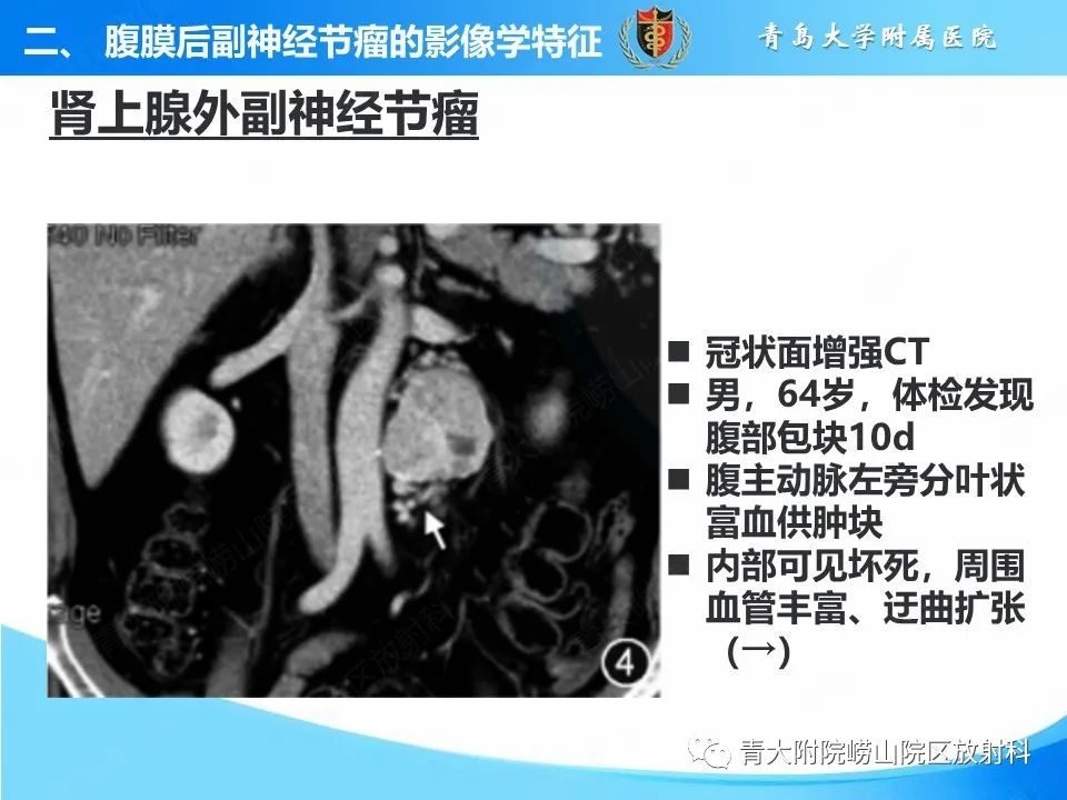 影像PPT - 【病例】腹膜后副神经节瘤1例CT影像-28