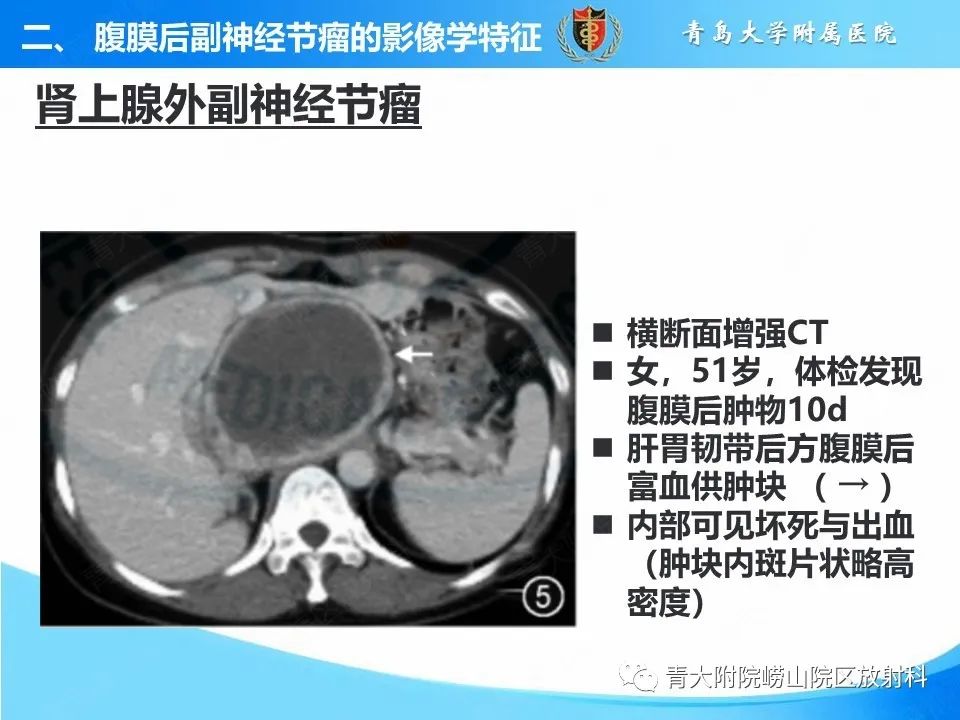 影像PPT - 【病例】腹膜后副神经节瘤1例CT影像-29