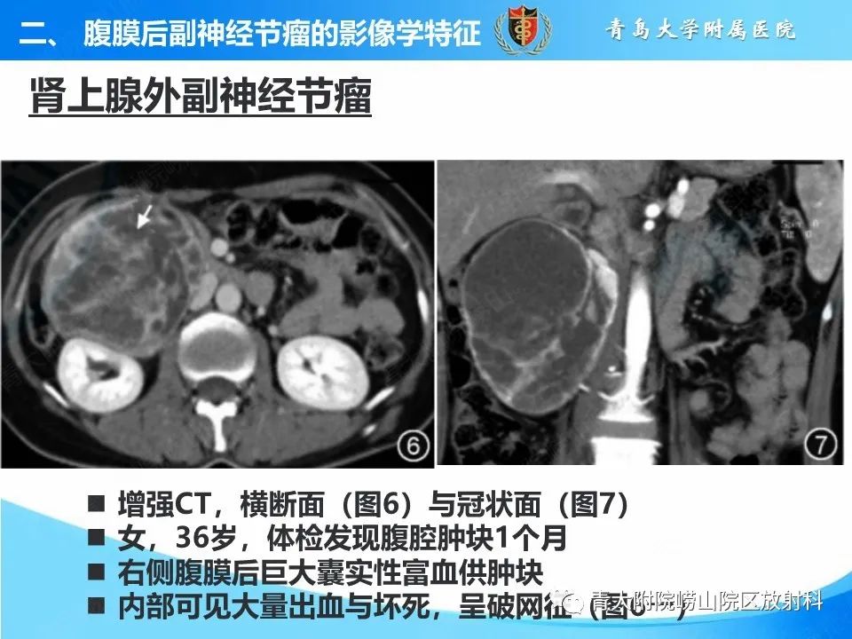影像PPT - 【病例】腹膜后副神经节瘤1例CT影像-30