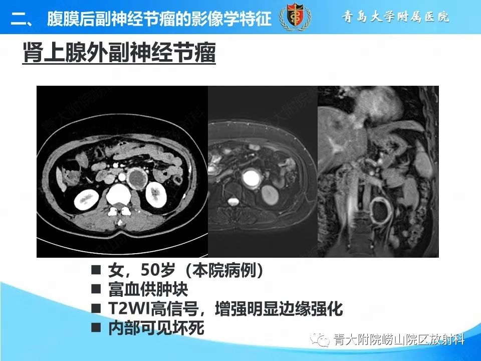影像PPT - 【病例】腹膜后副神经节瘤1例CT影像-26