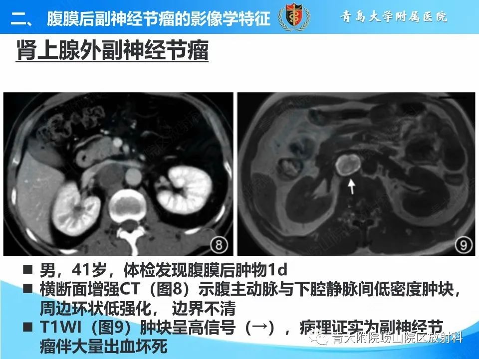 影像PPT - 【病例】腹膜后副神经节瘤1例CT影像-32