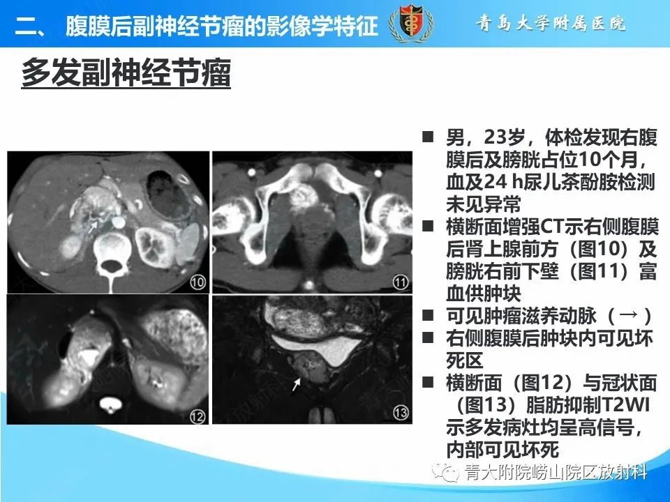 影像PPT - 【病例】腹膜后副神经节瘤1例CT影像-33