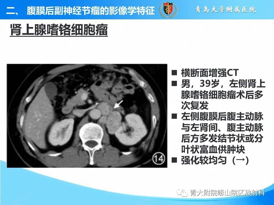 影像PPT - 【病例】腹膜后副神经节瘤1例CT影像-36