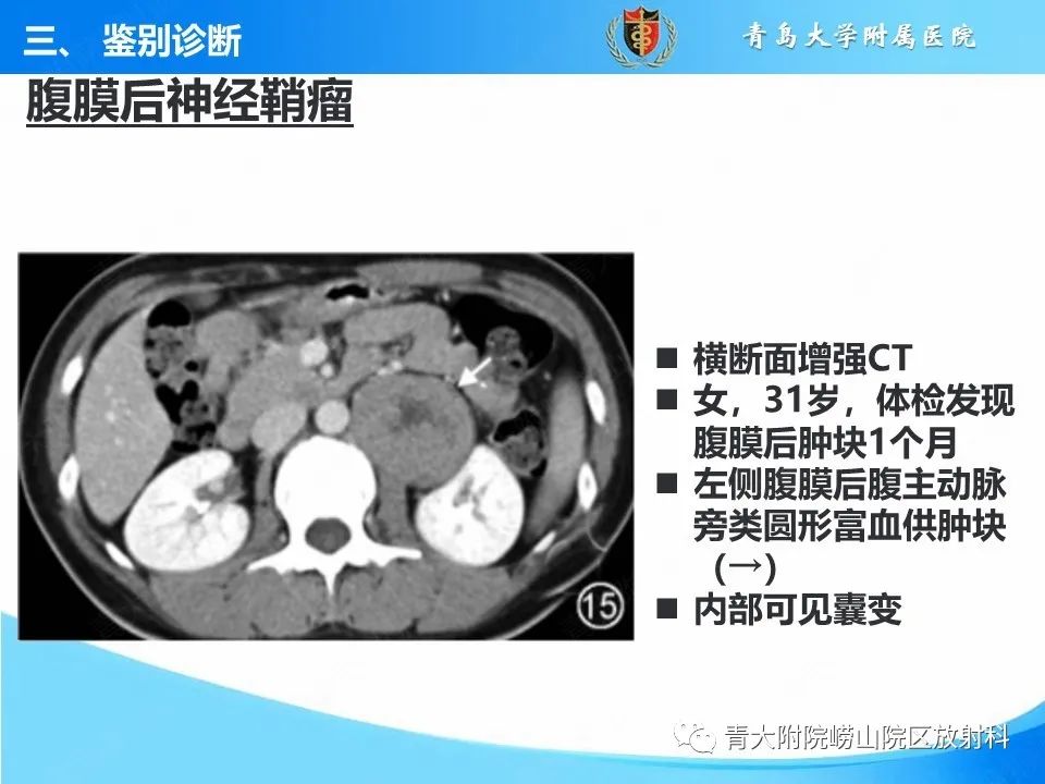 影像PPT - 【病例】腹膜后副神经节瘤1例CT影像-40
