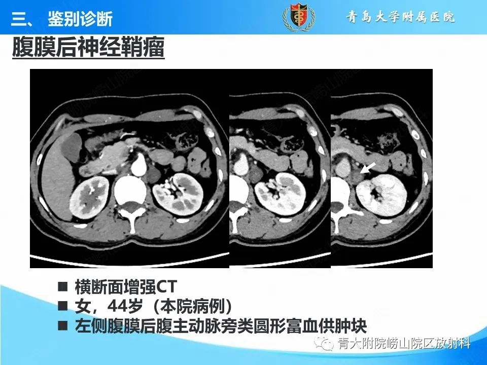 影像PPT - 【病例】腹膜后副神经节瘤1例CT影像-41