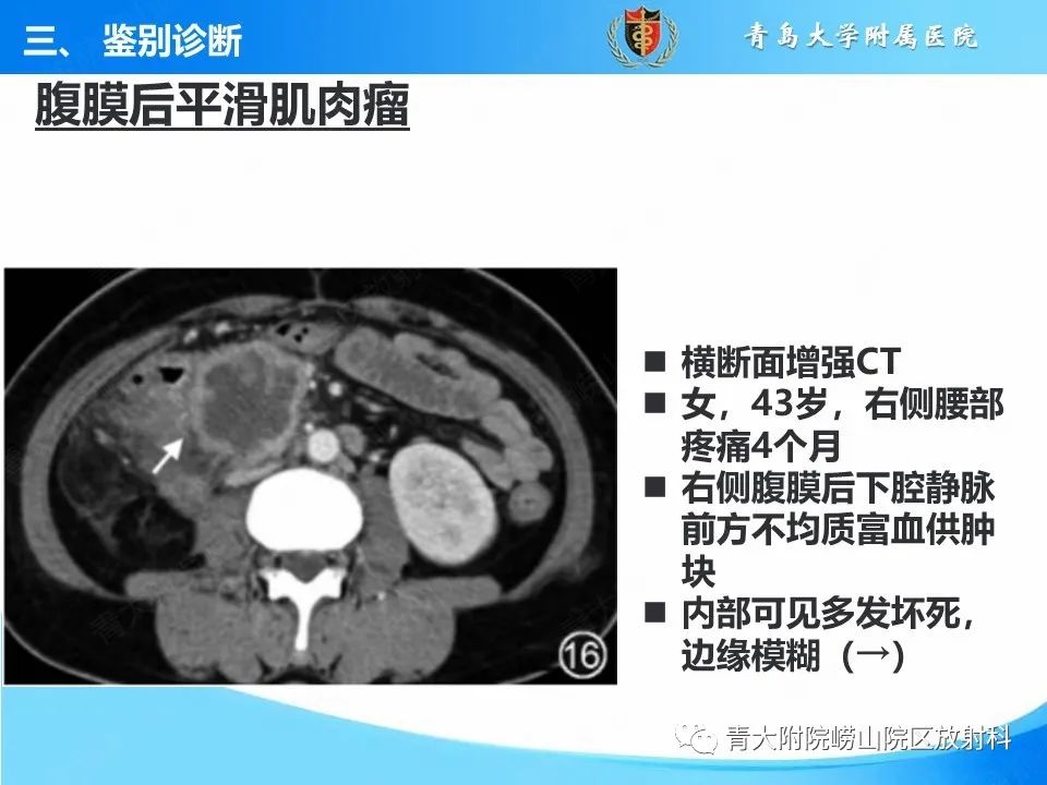 影像PPT - 【病例】腹膜后副神经节瘤1例CT影像-44