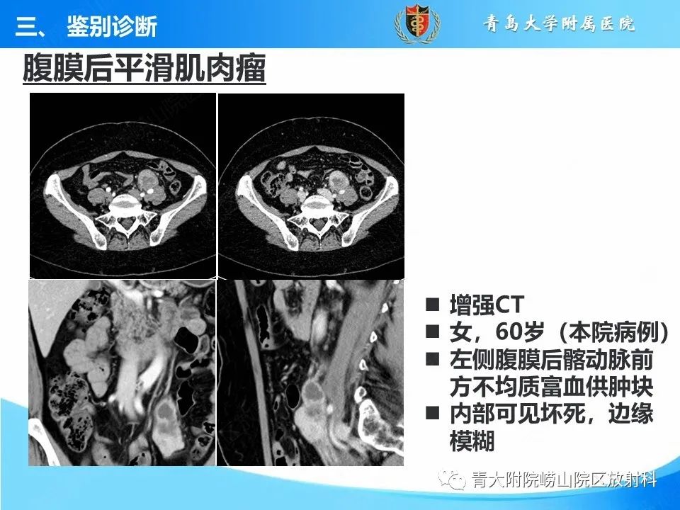 影像PPT - 【病例】腹膜后副神经节瘤1例CT影像-45