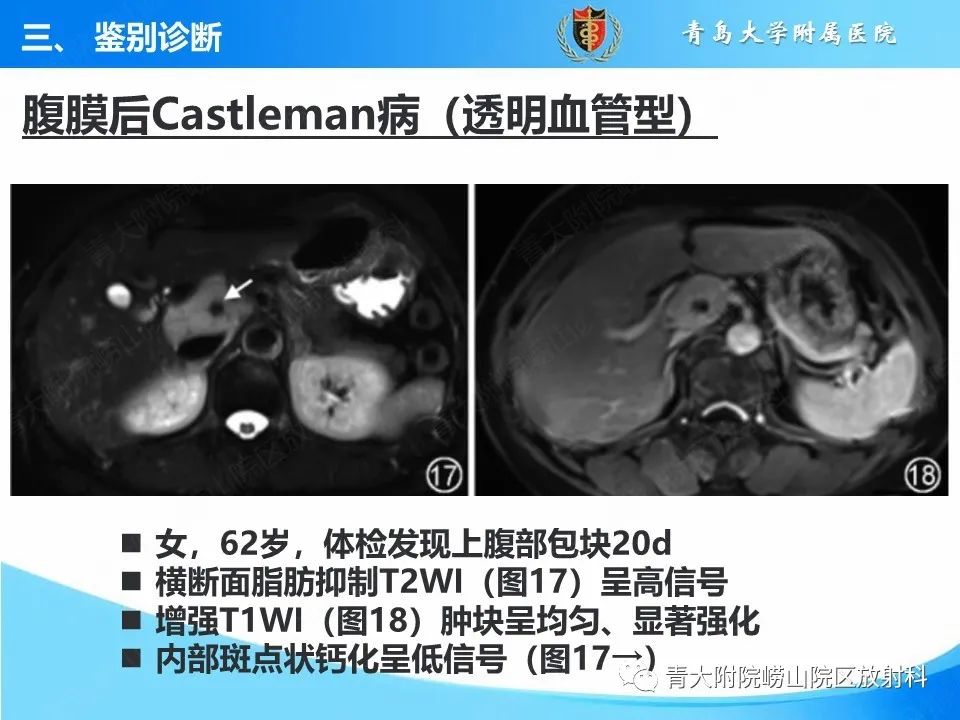 影像PPT - 【病例】腹膜后副神经节瘤1例CT影像-48