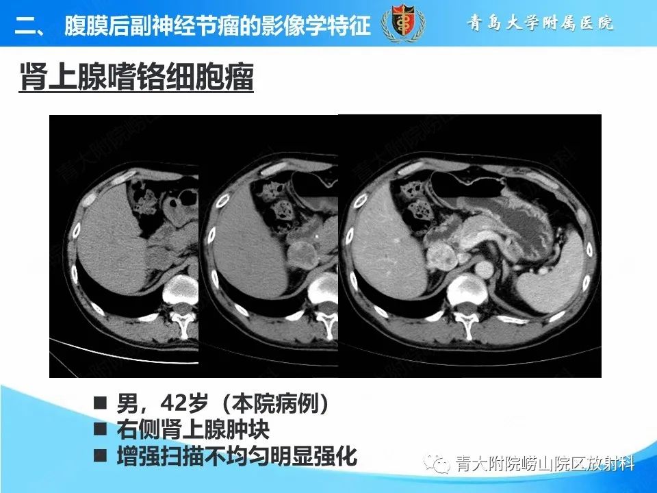 影像PPT - 【病例】腹膜后副神经节瘤1例CT影像-1
