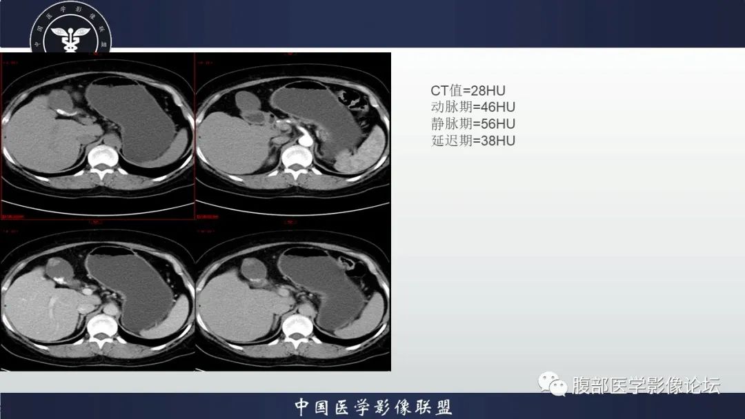 影像PPT - 【病例】胆囊管状腺瘤1例CT及MR影像表现-3
