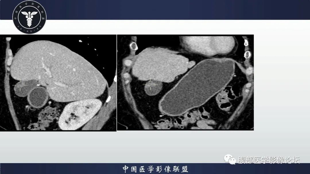 影像PPT - 【病例】胆囊管状腺瘤1例CT及MR影像表现-4