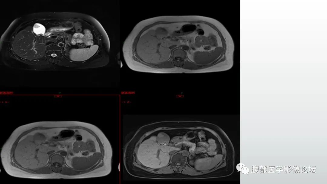 影像PPT - 【病例】胆囊管状腺瘤1例CT及MR影像表现-5