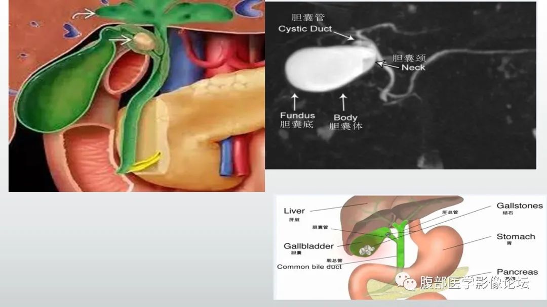 影像PPT - 【病例】胆囊管状腺瘤1例CT及MR影像表现-10