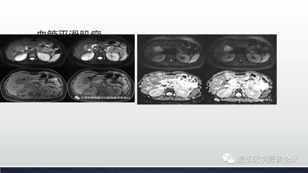 影像PPT - 【病例】胆囊管状腺瘤1例CT及MR影像表现-15