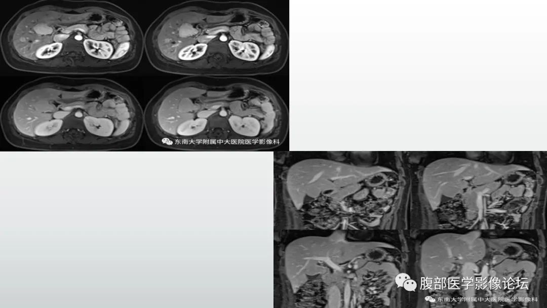 影像PPT - 【病例】胆囊管状腺瘤1例CT及MR影像表现-16