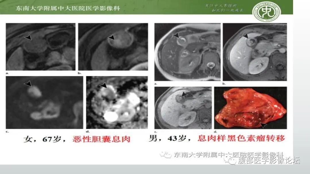 影像PPT - 【病例】胆囊管状腺瘤1例CT及MR影像表现-18