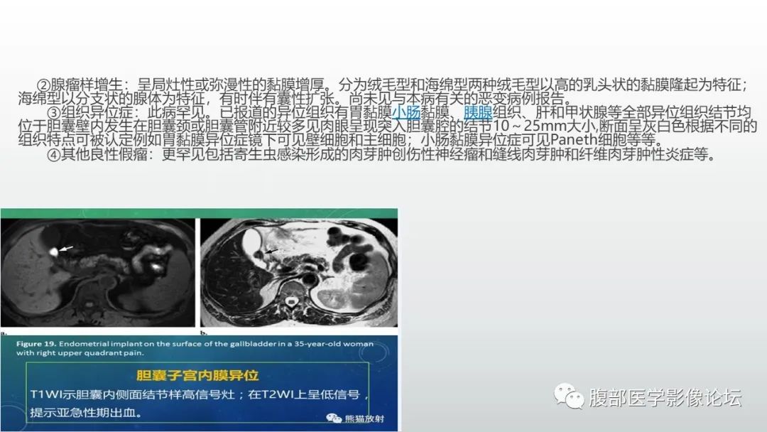 影像PPT - 【病例】胆囊管状腺瘤1例CT及MR影像表现-20