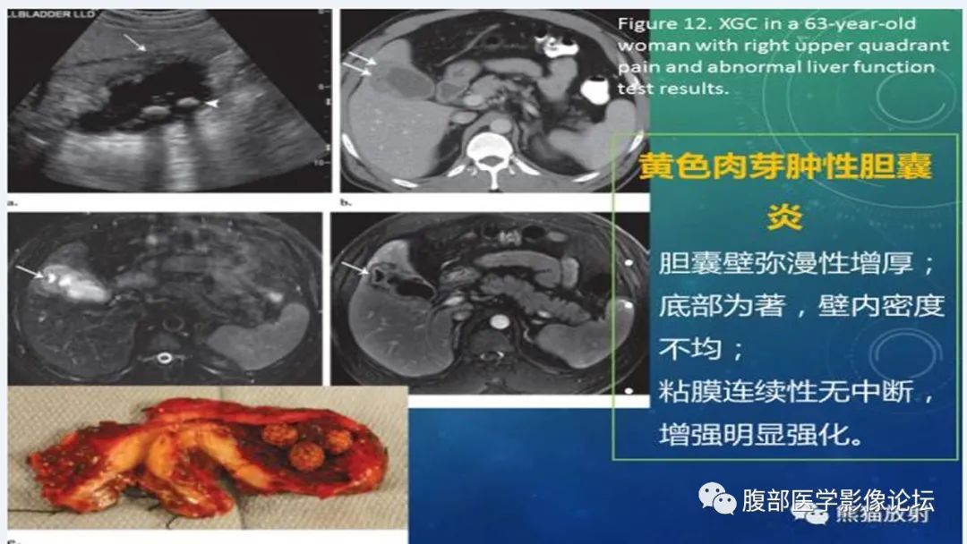 影像PPT - 【病例】胆囊管状腺瘤1例CT及MR影像表现-21