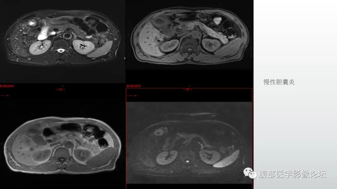 影像PPT - 【病例】胆囊管状腺瘤1例CT及MR影像表现-22