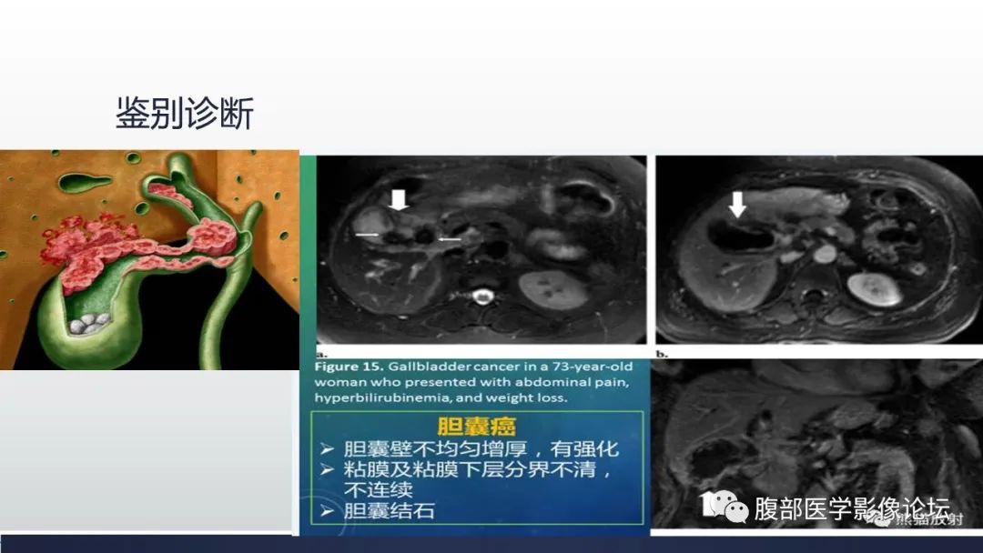影像PPT - 【病例】胆囊管状腺瘤1例CT及MR影像表现-23