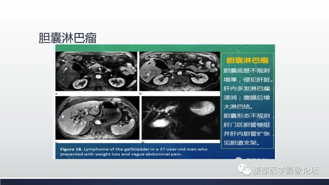影像PPT - 【病例】胆囊管状腺瘤1例CT及MR影像表现-24