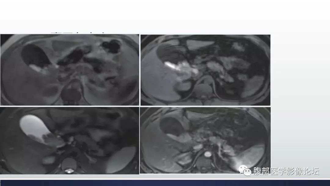 影像PPT - 【病例】胆囊管状腺瘤1例CT及MR影像表现-25