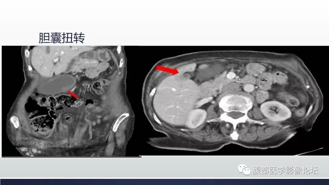 影像PPT - 【病例】胆囊管状腺瘤1例CT及MR影像表现-26