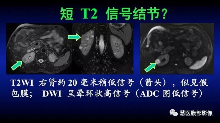 影像PPT - 【PPT】肾脏短T2局灶病变MRI表现与鉴别诊断思路-6