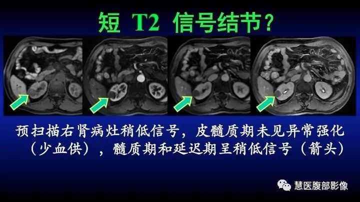 影像PPT - 【PPT】肾脏短T2局灶病变MRI表现与鉴别诊断思路-8