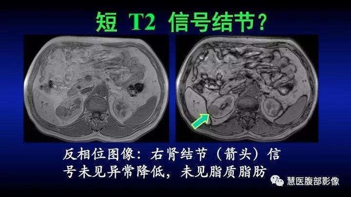 影像PPT - 【PPT】肾脏短T2局灶病变MRI表现与鉴别诊断思路-7