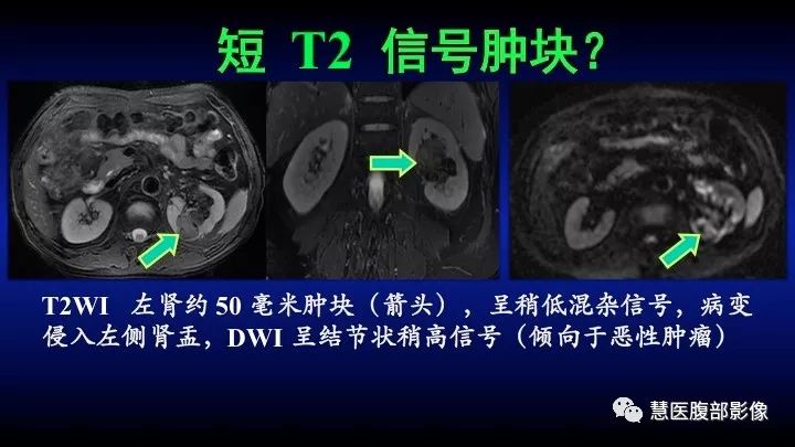 影像PPT - 【PPT】肾脏短T2局灶病变MRI表现与鉴别诊断思路-11