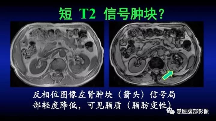 影像PPT - 【PPT】肾脏短T2局灶病变MRI表现与鉴别诊断思路-12
