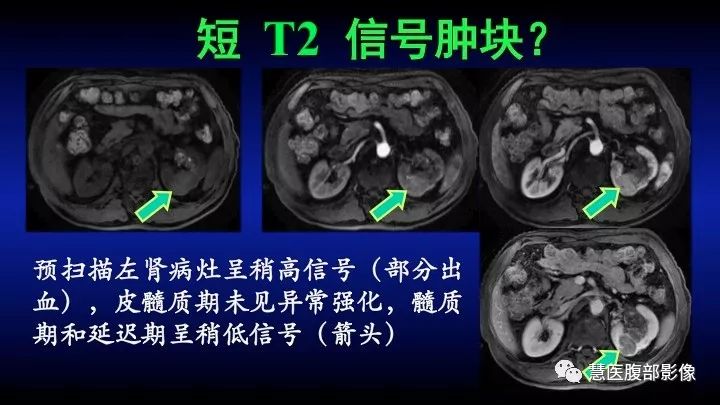 影像PPT - 【PPT】肾脏短T2局灶病变MRI表现与鉴别诊断思路-13